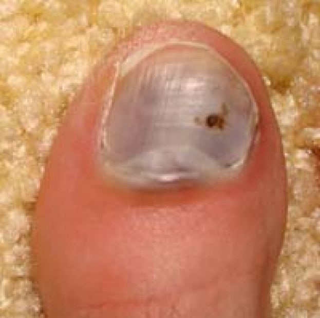 ASPETTANDO IL MEDICO:EMATOMA SOTTOUNGUEALE